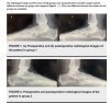 Comparison of Isolated Calcaneal Spur Excision and Plantar Fasciotomy in Addition to Spur Excision in Patients With Plantar Heel Pain Accompanied by Calcaneal Spur