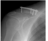 Kemal Gokku§, Murat Saylik, Ahmet Turan Aydin;Tightrope fixation of neer type II distal clavicle fracture supported by a case series. Pol Orthop Traumatol,Kemal Gokku§, Murat Saylik, Ahmet Turan Aydin