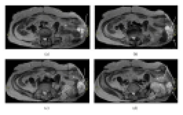 Kemal Gökkuş, Tolgay Akin,Ergin Sagtas, Murat Saylik,  Ahmet Turan Aydın;Recurrence of Pelvic Chondrosarcoma through Fascial Defect into Abdominal Cavity