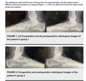 Comparison of Isolated Calcaneal Spur Excision and Plantar Fasciotomy in Addition to Spur Excision in Patients With...
