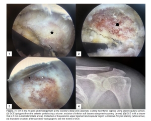 Open and arthroscopic excision of the distal clavicle for osteoarthritis of the acromioclavicular joint--results over 5...