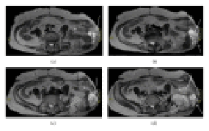 Kemal Gökkuş, Tolgay Akin,Ergin Sagtas, Murat Saylik, Ahmet Turan Aydın;Recurrence of Pelvic Chondrosarcoma through Fascial Defect into Abdominal Cavity