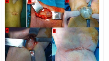 Treatment of baker cyst, by using open posterior cystectomy and supine arthroscopy on recalcitrant cases