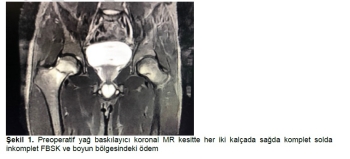 26 Yaşındaki Genç Maden İşçisinde Eş Zamanlı İki Taraflı Femur Boyun Stres Kırığı.