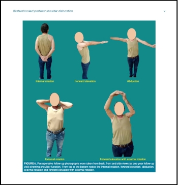 Bilateral locked posterior shoulder dislocation overlooked for 15 months treated with the modified McLaughlin procedure: A case report