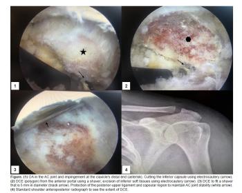 Open and arthroscopic excision of the distal clavicle for osteoarthritis of the acromioclavicular joint--results over 5 years