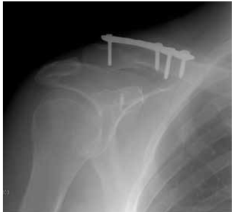 Kemal Gokku§, Murat Saylik, Ahmet Turan Aydin;Tightrope fixation of neer type II distal clavicle fracture supported by a case series. Pol Orthop Traumatol,Kemal Gokku§, Murat Saylik, Ahmet Turan Aydin