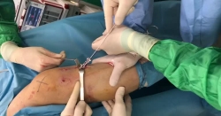Artroskopik Çapraz Bağ Onarımı