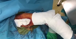 Omuz Protezi Hareket Açıklığı Kontrolü